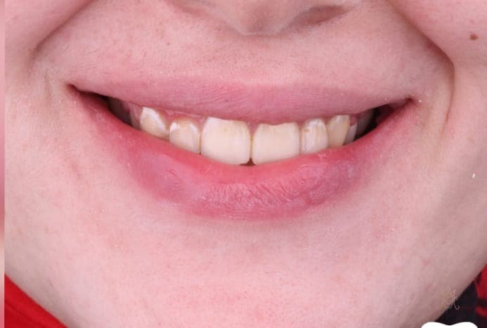 تجميل الأسنان الأمامية — بعد