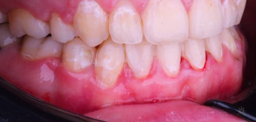علاج التسوّس واستعادة الشكل — بعد