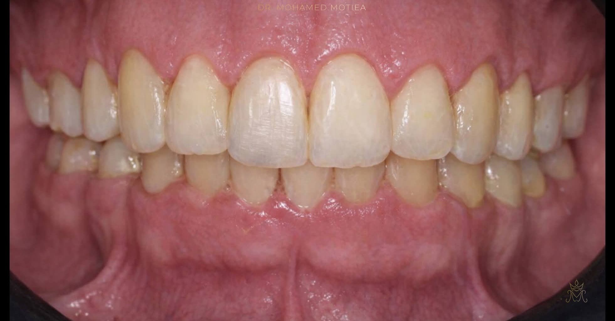 تجميل الابتسامة بالفينير — بعد