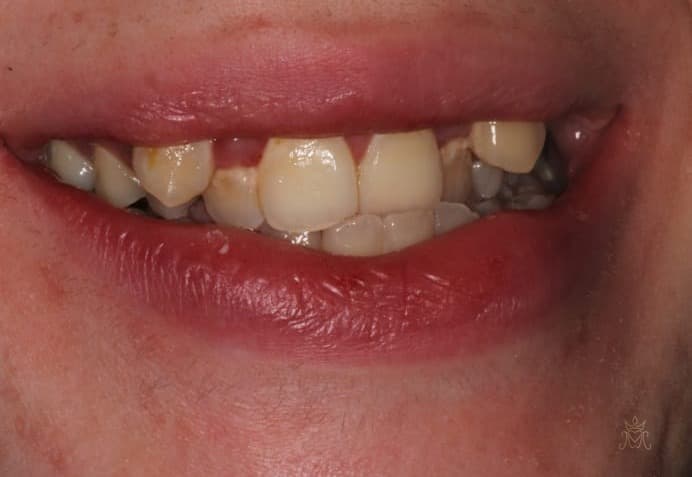 تجميل الأسنان الأمامية — قبل