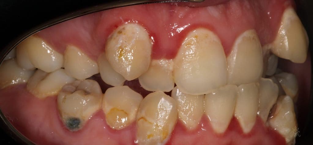 علاج التسوّس واستعادة الشكل — قبل