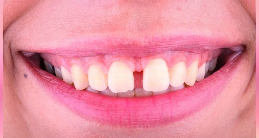 التقويم المكثف: إغلاق الفرجة — قبل