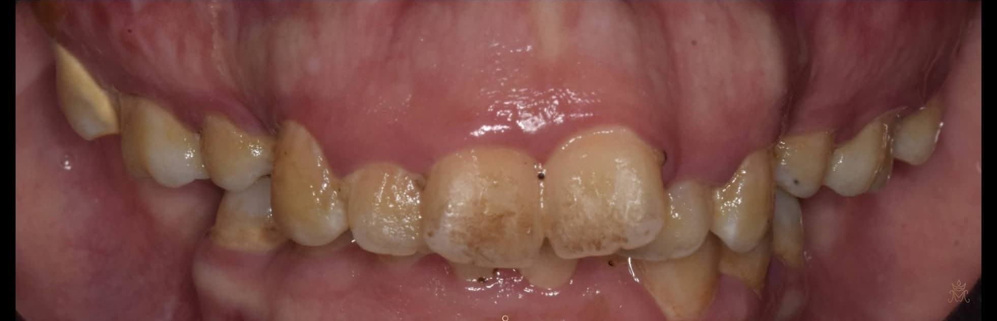 تجميل الابتسامة بالفينير — قبل